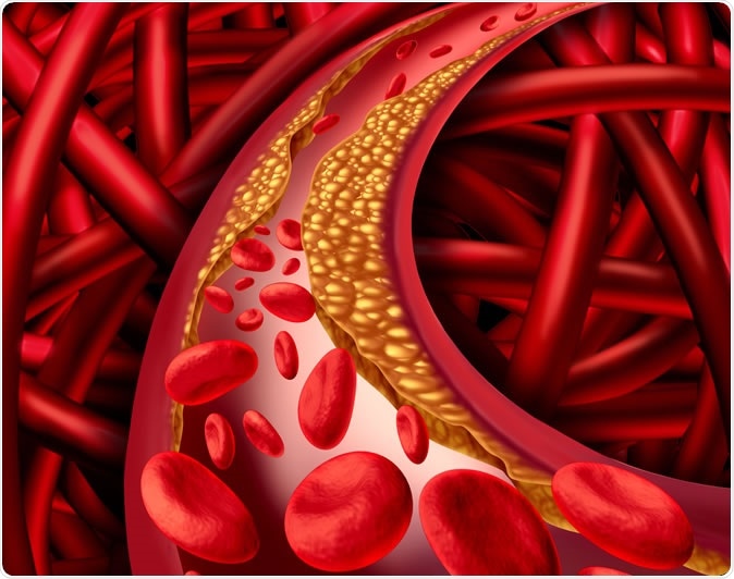 Artery problem with clogged arteries and atherosclerosis disease medical concept with a human cardiovascular system with blood cells with plaque buildup of cholesterol symbol of vascular illness. Image Credit: Lightspring / Shutterstock