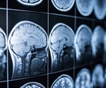 Study shows 53% of homeless people have suffered a traumatic brain injury