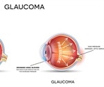 Ocular Hypertension: Diagnosis and Treatment