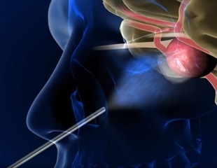 Recovery from Endoscopic Endonasal Surgery