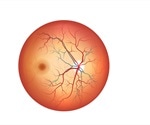 Optic Disc Swelling: Overview
