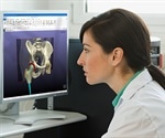 Synopsys release new software for implant design and patient-specific planning