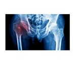 Hip fractures may serve as first sign of undiagnosed Alzheimer’s disease