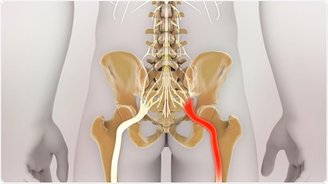 Sciatic Nerve Pain. Image Credit: Nathan Devery / Shutterstock