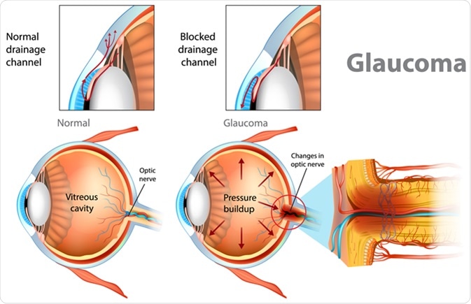 Glaucoma. Illustration showing open-angle glaucoma. Intraocular pressure in the back of the eye. Image Credit: Sakurra / Shutterstock