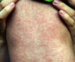 Measles alert at Sydney airport