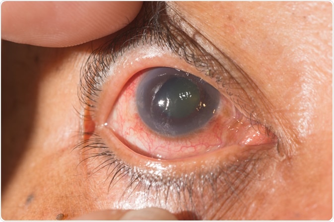 Close up of glaucoma during. Image credit: ARZTSAMUI / Shutterstock
