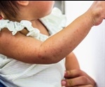 New Zealand faces dangerous measles outbreak with 25 confirmed cases