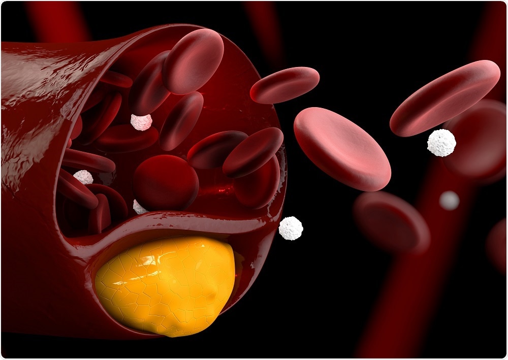 cholesterol builds up in the walls of arteries