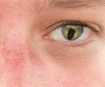 What Causes Coloboma?