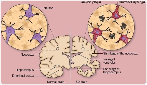 A comparison of a normal, healthy brain, with a brain affected with advanced Alzheimer