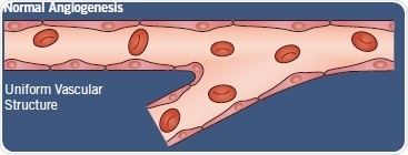 Normal angiogenesis versus tumor vascularization