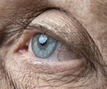 Low levels of certain eye proteins could serve as predictor for Alzheimer’s