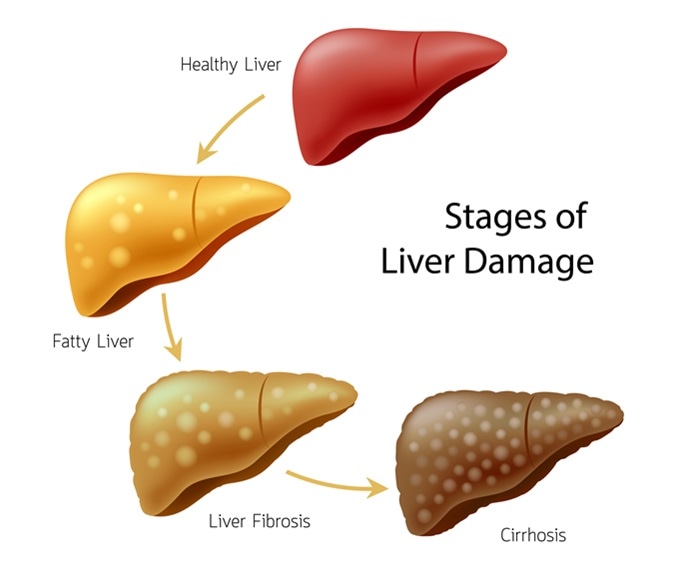 Stages of liver damage. Healthy, fatty, liver fibrosis and Cirrhosis. Image Credit: Shutterstock