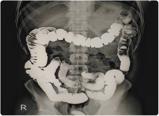 X-ray Barium enema showing normal colon mucosa. Image Credit: Richman Photo / Shutterstock