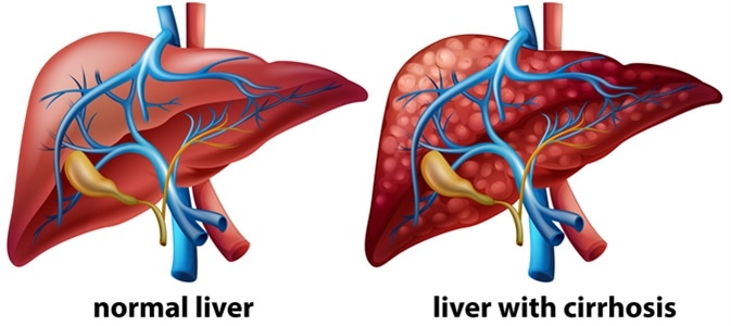 Cirrhosis of the liver illustration. Credit: BlueRingMedia / Shutterstock