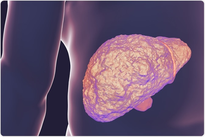 Liver with cirrhosis inside human body. 3D illustration. Image Credit: Kateryna Kon / Shutterstock