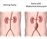 Abdominal Aortic Aneurysm (AAA): Causes, Symptoms, & Management
