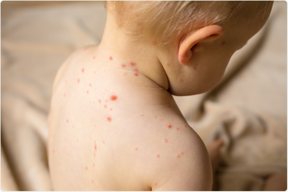 Measles is a contagious disease that is highly infectious
