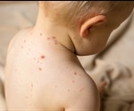The return of the measles: are we going backward?