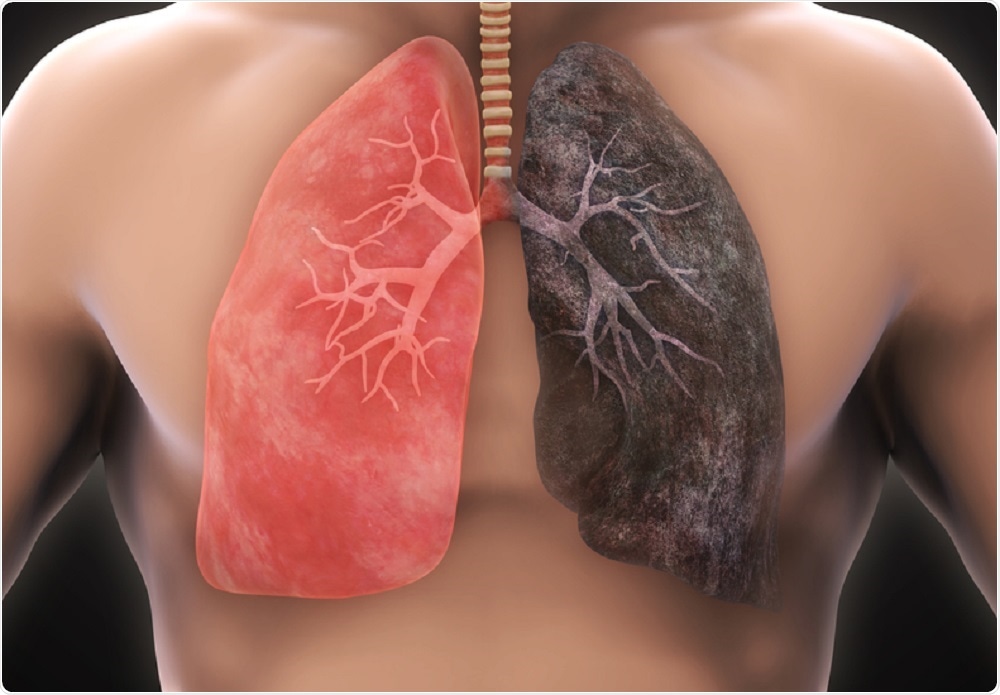 Healthy lung and lung with cancer