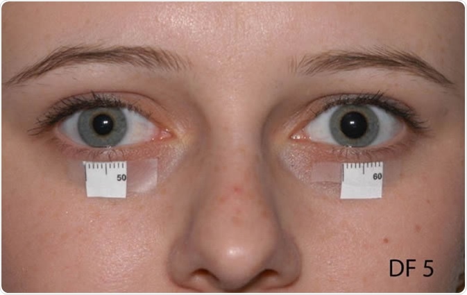 Horner Syndrome in a 17 year old. Image Credit: Moran Eye Center in partnership with the Eccles Library