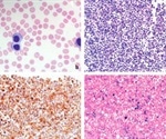 What is Large Granular Lymphocytic Leukemia (LGLL)?