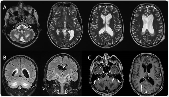X-linked adrenoleukodystrophy: MRI in a 32-year-old man presenting psychiatric troubles and cerebellar ataxia two years ago. Axial T2-WI (A) and coronal FLAIR (B) show vasogenic edema involving the corpus callosum, the corticospinal tract and the cerebellar WM. Postcontrast Axial T1 (C) shows the inflammatory zone enhances (white arrow). References: -Marseille/FR