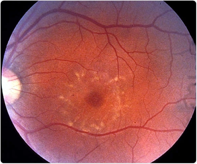 Fundus photo of patient with fundus flavimaculatus. Credit: Clinical Electrophysiology