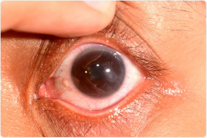 Close up of the keratitis during eye examination. Image Credit: ARZTSAMUI / Shutterstock