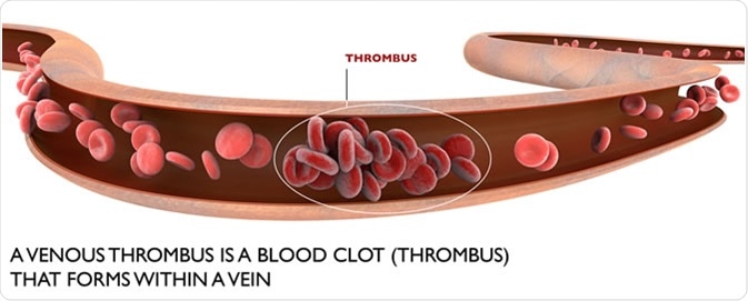 Deep vein thrombosis, a blood clot within a vein. Image Credit: Naeblys / Shutterstock
