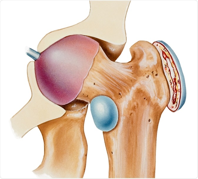 Hip - Bursitis. A bursa is a fluid filled sac that facilitates the smooth motion of joints. Image Credit: Medical Art Inc / Shutterstock