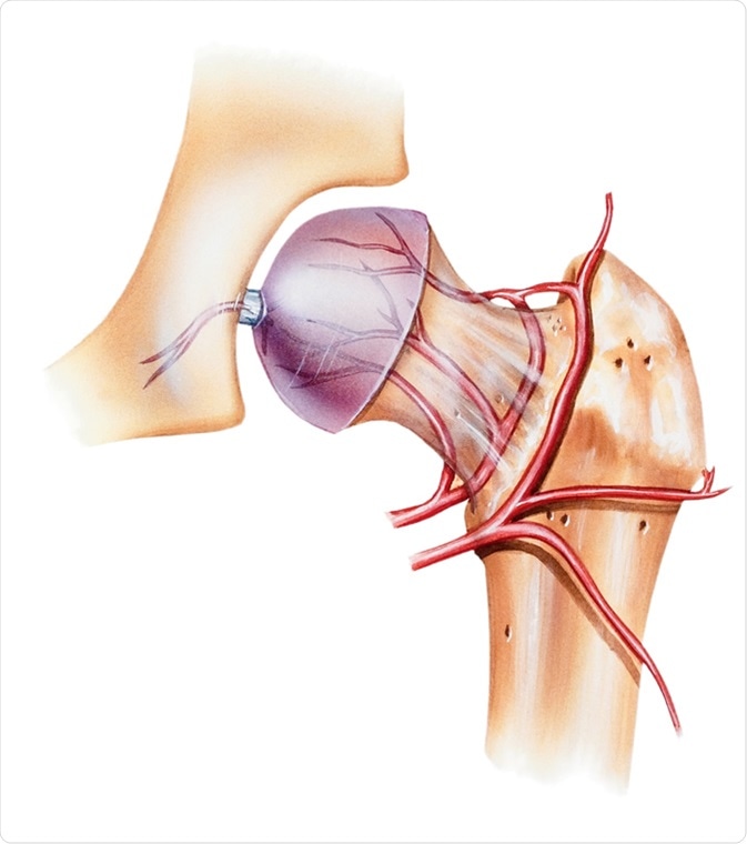Leg - Osteonecrosis of the Femoral Head front view. Shown are the round ligament and artery of the femoral head, medial circumflex femoral artery, and lateral circumflex femoral artery. - Illustration Credit: Medical Art Inc / Shutterstock