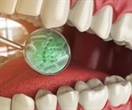 Gum disease bacterium releases toxins that may cause Alzheimer's