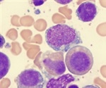 What are Myelodysplastic Syndromes?