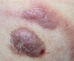 What is Cutaneous T-Cell Lymphoma?