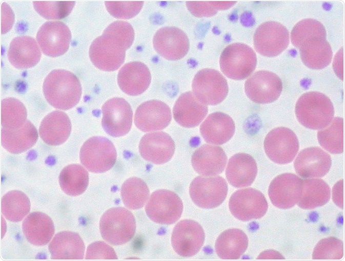 'Essential Thrombocythemia, Peripheral Blood