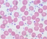 What is Essential Thrombocythemia?