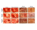 Plastic surgeons and scientists develop synthetic soft tissue substitute with fewer side effects