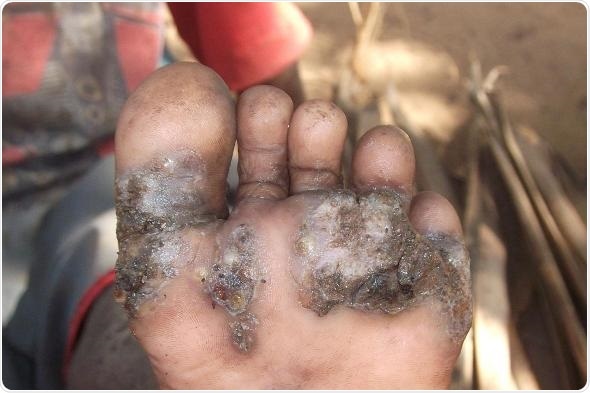Simple prevention methods could reduce tungiasis in children, study suggests