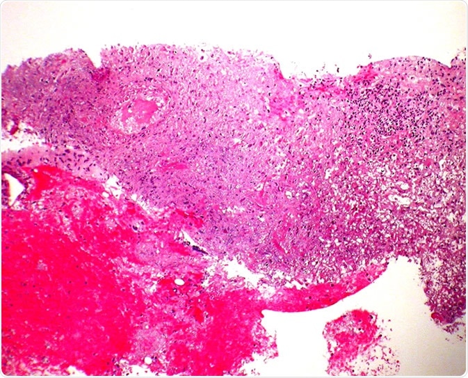 Granulomatosis with polyangiitis (GPA) - Core biopsy Case 190
