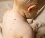 Experts Suggest Compulsory Measles Vaccination in Children Could Prevent Epidemic