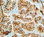 Novel gene expression signature assay could help enhance lymphoma management