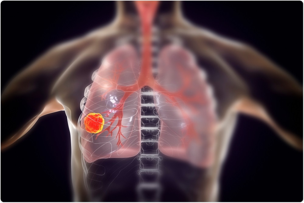 Google Artificial Intelligence researchers have developed an algorithm that can detect lung cancers with a 94.4 percent success rate.