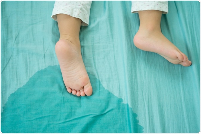Bedwetting (also known as nocturnal enuresis) is a condition in which there is an uncontrollable and involuntary leakage of urine from the bladder while asleep.