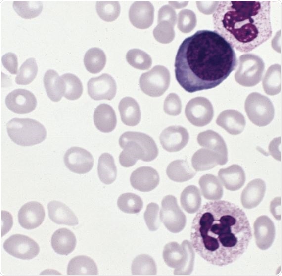 Blood smear from a patient with polycythemia vera