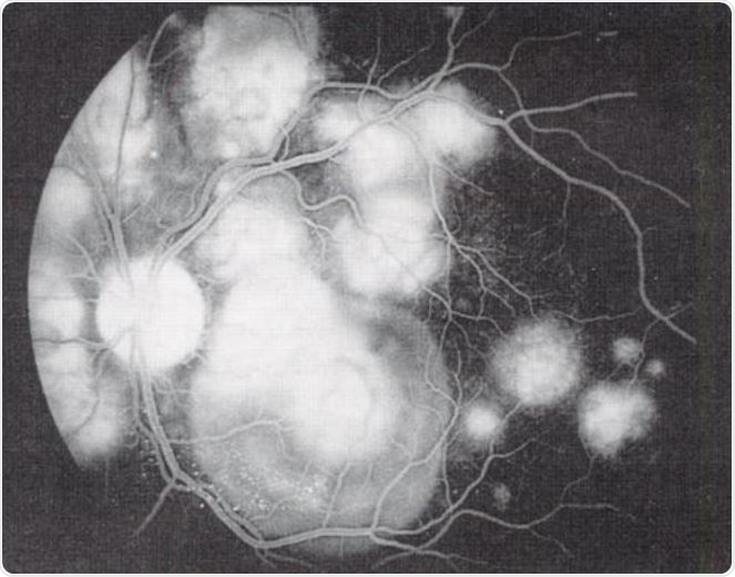 Acute Posterior Multifocal Placoid Pigment Epitheliopathy (APMPPE). Image Credit: uveitis.org