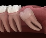 Study shows positive long-term effects of wisdom teeth extraction on taste function