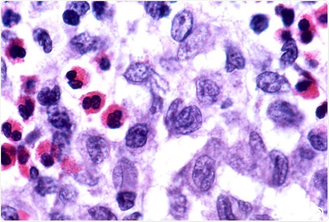 'Langerhans cell histiocytosis