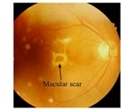 Study aims to understand role of immune cells in the development of macular scarring